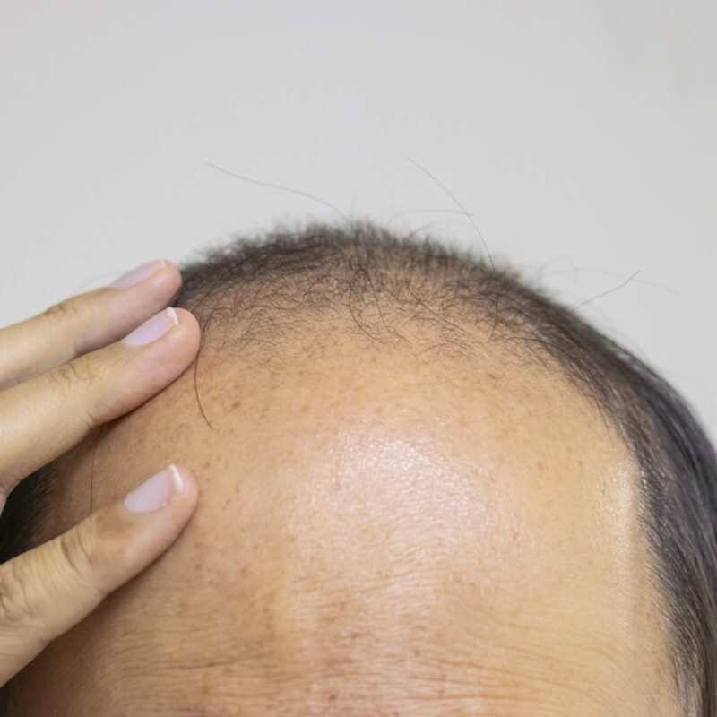 bpc 157 hair transplant Best Peptides for Hair Growth: GHK-Cu & Beyond (Doctor-Ranked 2026)