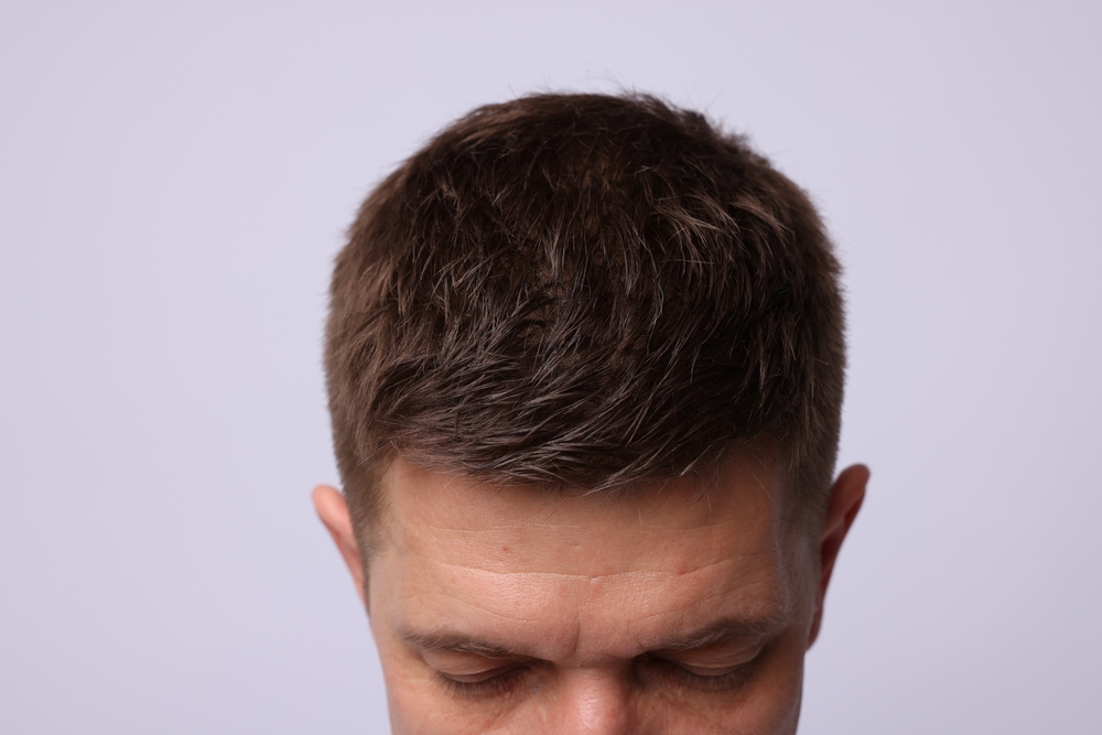 Biohacking Your Hairline: Practical Tips for Using Peptide Droppers to Combat Recession